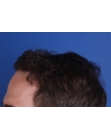 After Hair Transplant&nbsp;Front